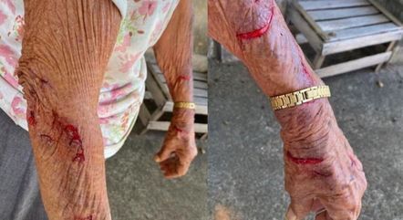 Idosa teve lesões sérias nos braços ao ser amarrada
