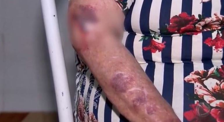 Nem sempre a violência deixa marcas nos idosos, mas há casos com hematomas