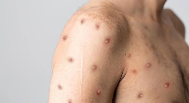 Imagem de pessoa infectada pela varíola dos macacos. (Foto: Reprodução/UOL)