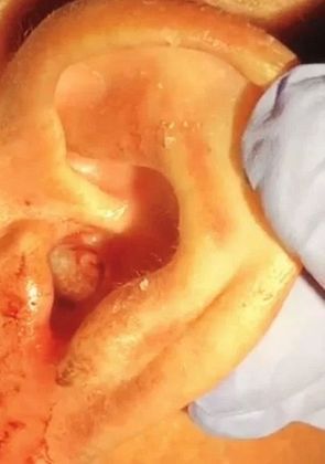 Os vermes eram da espécie Cochliomyia hominivorax, uma larva de mosca parasítica, famosa por comer tecidos de animais. As fêmeas põem ovos em bichos de sangue quente, e quando tais larvas eclodem devoram a pele e outros tecidos. Se não for tratado, casos do tipo podem ser fataisNÃO PERCA: Família exuma avó enterrada há 10 anos e se surpreende com aparência: 'Pele intacta e incrível'