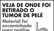 Pelé está bem, mas segue internado em UTI em São Paulo