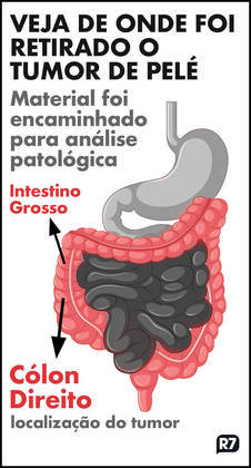 info, tumor Pelé