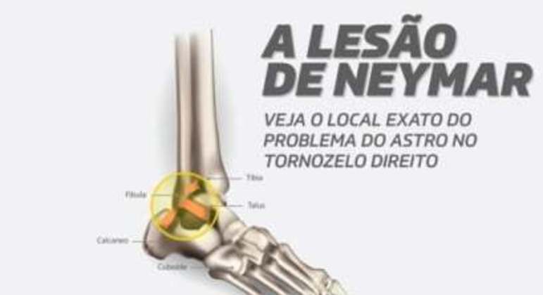 Infográfico - Lesão neymar