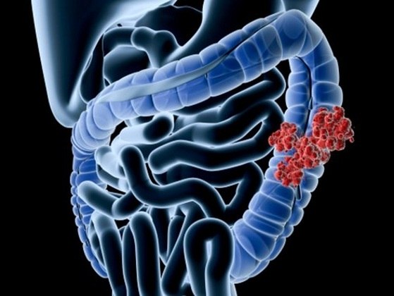 intestino intestino
