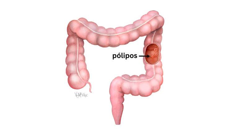 A maioria dos cânceres colorretais tem origem em crescimentos chamados pólipos, localizados no revestimento interno do cólon ou reto. Embora nem todos os pólipos se transformem em câncer, alguns tipos podem sofrer essa mudança ao longo de muitos anos.  A probabilidade de um pólipo evoluir para câncer varia de acordo com o tipo em questão, já que existem variações