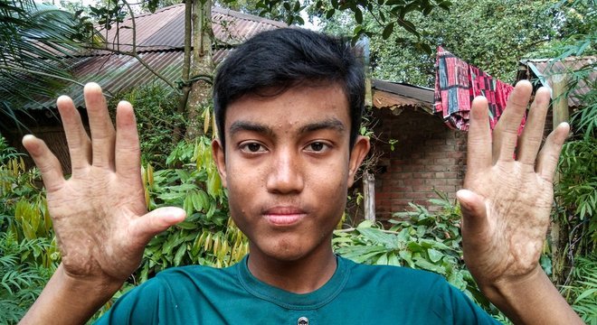 Irmão mais novo de Apu Sarker, Anu, também herdou a rara mutação genética