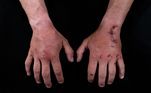 Lutador de MMA ou triatleta? Olha o resultado das mãos dele após as atividades