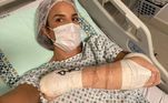 Ivete Sangalo sofre acidente esquiando e faz cirurgia no braçoA cantora se machucou durante suas férias no Chile, mas fez questão de voltar ao Brasil para se tratar. Em um post feito nas redes sociais, ela disse que o procedimento foi um sucesso. ''Mainha tá zero bala'', escreveu.