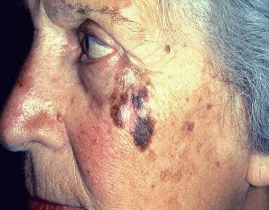 Já o melanoma lentigo maligno acomete mais os idosos e é o mais ligado à exposição solar ao longo da vida. 