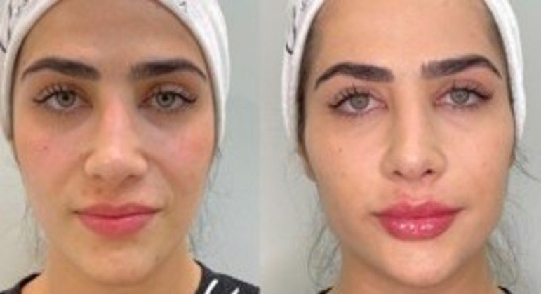 Jéssica Costa antes e depois de fazer harmonização facial