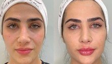 Jéssica Beatriz Costa, filha de Leonardo, faz harmonização facial; veja o antes e o depois