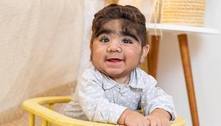 Bebê peludo viraliza na web; entenda a condição que o afeta