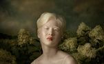O albinismo ocorre em todos os grupos étnicos e raciais e as pessoas podem ter diferentes níveis de pigmentação, de acordo com o tipo específico da doença, que também pode afetar a capacidade de enxergar. Xueli, por exemplo, tem no máximo 10% de visão e seus olhos são extremamente sensíveis à luz