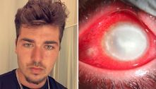 'Parasitas carnívoros comeram meu olho': jovem perde visão após dormir usando lentes de contato