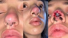 Jovem fica com o nariz necrosado após procedimento estético malsucedido