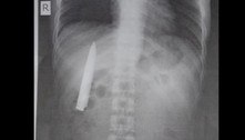 Jovem descobre lâmina cravada no peito 14 meses após levar facada 