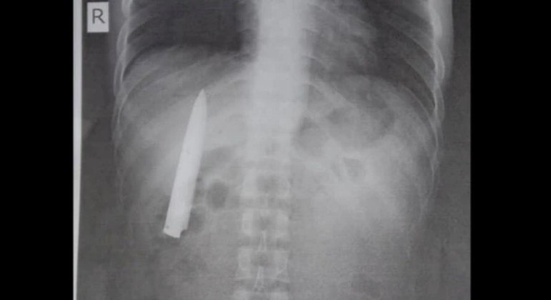 Jovem de 25 anos passou 14 meses com lâmina de faca enterrada no peito