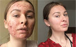 A ucraniana Mariia Bilenka, de 23 anos, passou a adolescência toda se escondendo por causa da quantidade de acnes que tinha no rosto. Depois de passar por inúmeros médicos e tentar vários tratamentos para a pele, ela descobriu que o problema estava na sua alimentação 