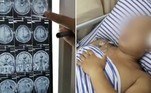 Um jovem chinês passou aproximadamente 17 anos com um verme de 12,7 cm alojado dentro do cérebro