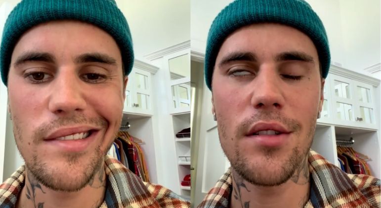 Justin Bieber está com metade do rosto paralisada