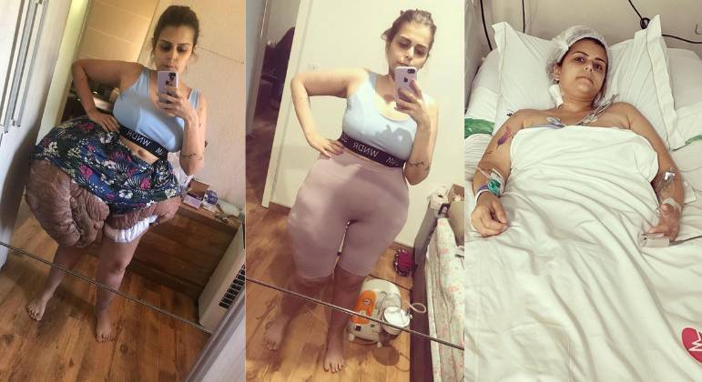 Karina passa por diversas cirurgias para remover tumor de cerca de 40kg