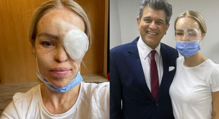 Katie Piper passa por cirurgia de emergência no olho esquerdo