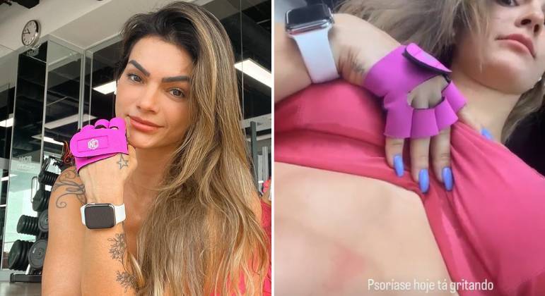 Kelly Key disse que psoríase levou a descobrir outras disfunções de saúde
