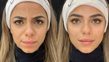 Key Alves mostra antes e depois de procedimentos no rosto