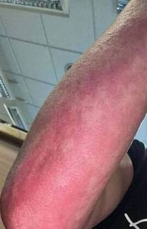 Mulher tem crise alérgica após comer ingrediente oculto em sanduíche (Reprodução/ Edinburgh Live WS)