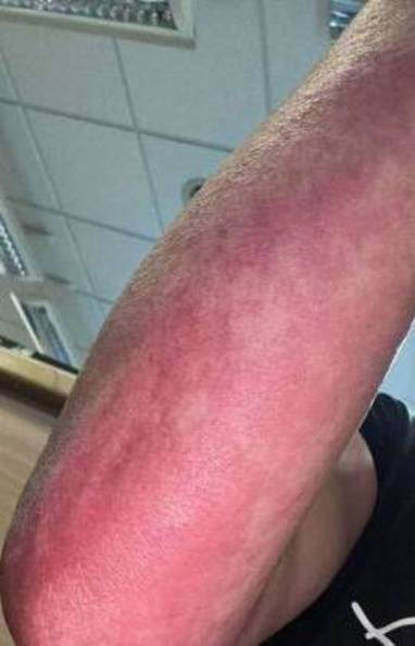 Mulher tem crise alérgica após comer ingrediente oculto em sanduíche (Reprodução/ Edinburgh Live WS)