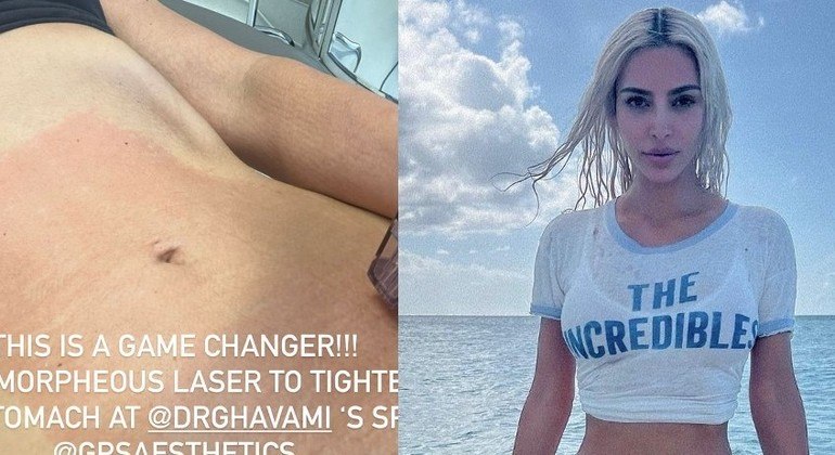 Kim Kardashian mostrou a barriga vermelha após tratamento para apertar o estômago