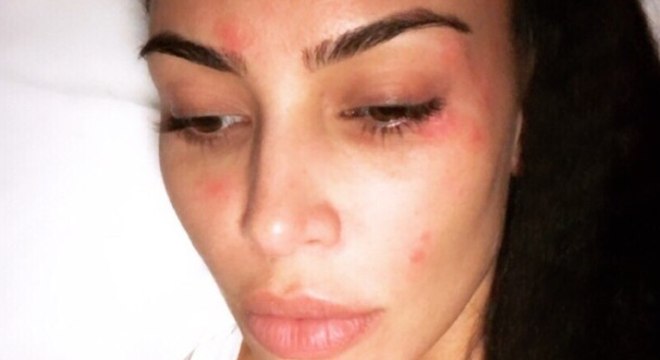 Entenda A Psoriase Doenca De Pele Que Afeta Rosto De Kim Kardashian Noticias R7 Saude