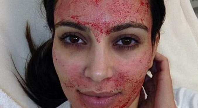 Kim Kardashian mostrou o tratamento com sangue