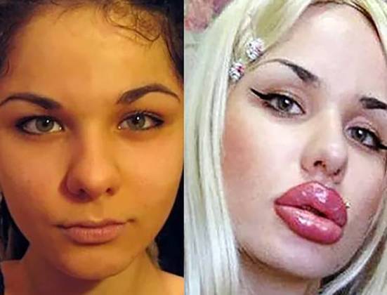 Kristina Rei -Essa jovem russa chamou atenção em 2011, ao começar a aumentar o tamanho dos lábios. Ela tinha 22 anos e já havia tomado mais de 100 injeções de silicone. 