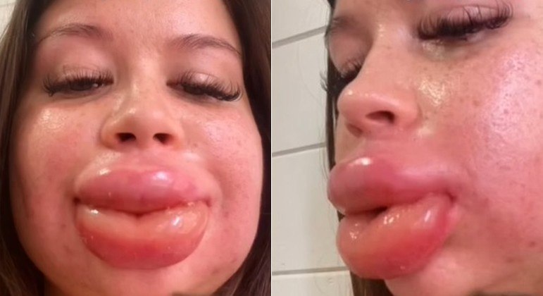 Lábios de jovem dobraram de tamanho após preenchimento dar errado