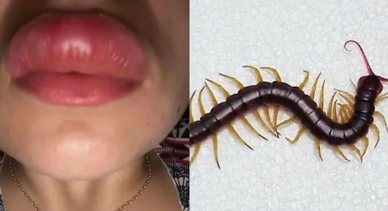 A picada de lacraia no lábio é dolorosa e provocou inchaço; estudante foi levada ao hospital