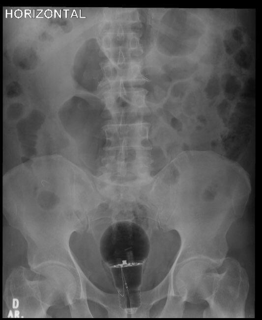 Exame de raio-X mostra a lâmpada inserida no ânus do paciente