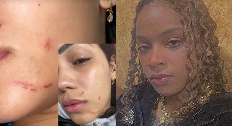 Larissa postou foto em que mostra machucados após ter acusado MC Dricka de violência doméstica