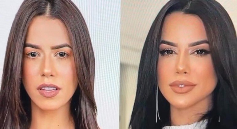 Larissa Tomásia antes e depois da harmonização facial