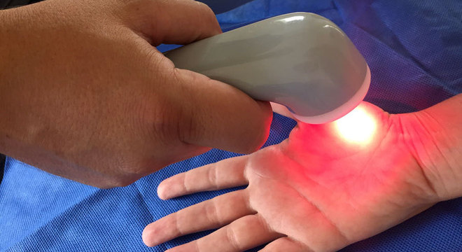O tratamento Foto Sônico é aplicado nas mãos, mas causa efeito em todo o corpo