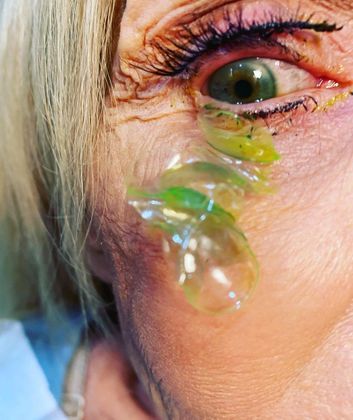 Uma oftalmologista da Califórnia, nos Estados Unidos, viralizou nas redes sociais recentemente após mostrar um procedimento para remover 23 lentes de contato do olho de uma paciente. Quando a especialista foi questionada sobre como pode alguém não ter percebido que havia algo no olho, ela admitiu que nem a própria paciente entendeu como isso pôde acontecer, mas que há uma explicação possível