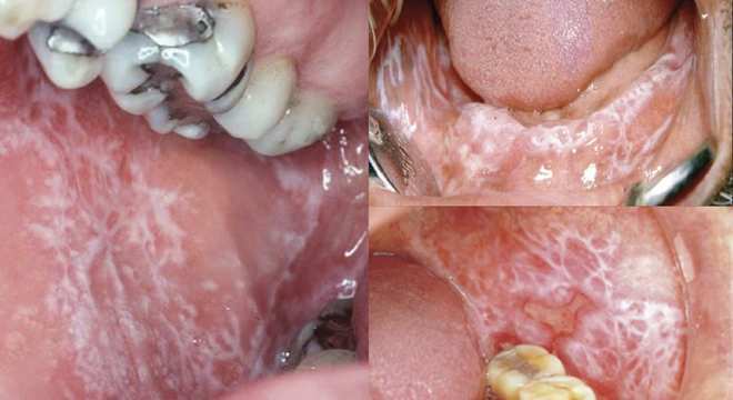 Língua branca pode ser um sinal de doença ou apenas má higiene bucal?