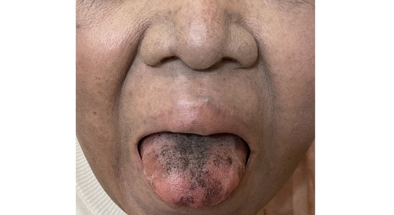 Além da pigmentação, língua da paciente estava dolorida no momento do diagnóstico