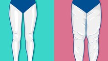 Conheça a doença que provoca deformação corporal e é confundida com obesidade