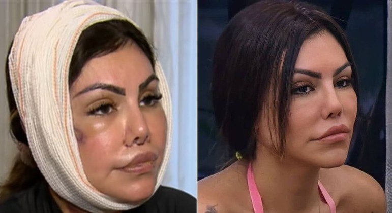 Liziane Gutierrez, de 35 anos, que participou de A Fazenda 13, disse durante uma conversa no reality show que foi vítima de uma harmonização facial malsucedida por causa do excesso de produto aplicado em seu rosto.
