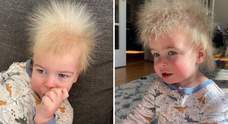 Criança diagnosticada com síndrome do cabelo que não se penteia vira  sucesso nas redes sociais - SIC