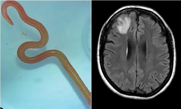 Lombriga normalmente encontrada em cobras é retirada viva do cérebro de ...