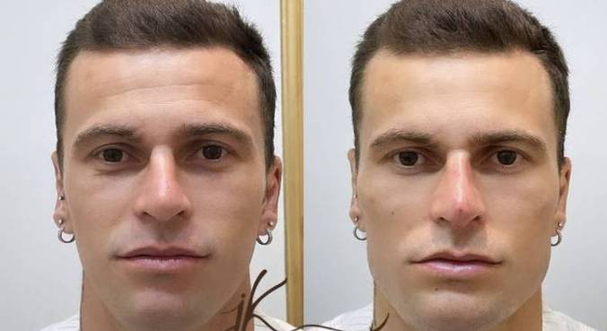 Paraense Bruno Diferente faz harmonização facial e mostra