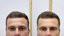 Lucas Lima mostra antes e depois de harmonização facial