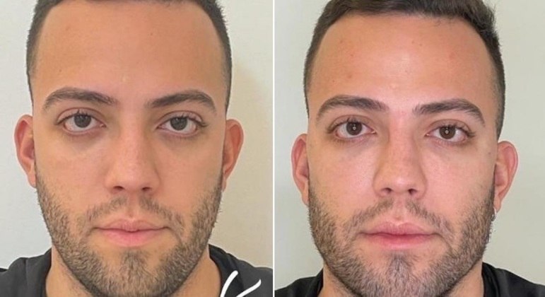 Lucas RangelO influenciador, de 25 anos, foi uma das celebridades de pouca idade que fizeram harmonização facial neste ano. O criador de conteúdo digital mudou alguns detalhes do rosto em fevereiro. Na época, ele revelou que já passava pelo procedimento havia alguns anos. No tratamento mais recente, ele fez rinomodelação, colocou Botox na testa, modelou o maxilar  e brincou: 'Cheguei lá e falei assim: 'Vocês podem me reconstruir''